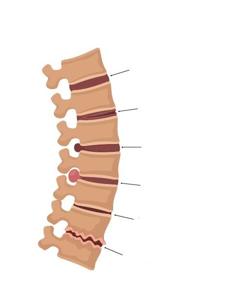 bony changes in the spine