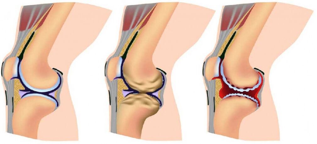 Healthy articulation affected by osteoarthritis