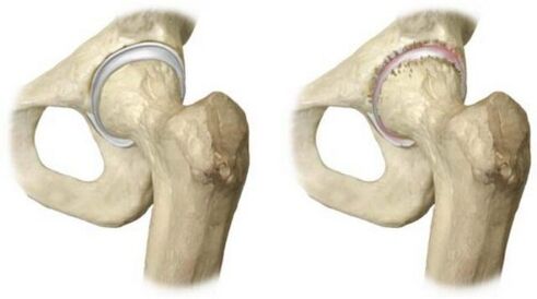 healthy and osteoarthritis hip joint